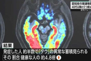 “認知症発症関わるたんぱく質”うつ病患者の脳に高割合で蓄積