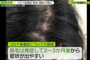 新型コロナ1/4が後遺症 8割9割が ハゲの悩み