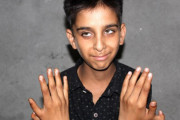 【ポジティブ思考】指が12本あるインドの少年「ゲームにも便利だし神様からの贈り物」