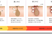 これやったらにきび出来なくなったって事教えて
