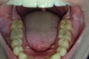 ワイのやばい虫歯見てくれ（※画像あり）