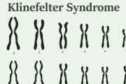 男性の500人に1人、染色体異常により病気のリスクが高い