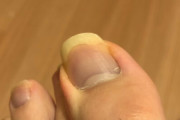 【病気のサイン？】指の爪の色がおかしくなったしまった
