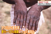 【悲報】サル痘、ガチでヤバい