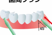 【衝撃】歯石除去し、歯間ブラシ（夜だけでもOK）使用　口臭激減