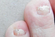 【悲報】爪水虫、罹ったら終わりｗｗｗｗｗｗｗｗｗｗｗｗｗｗｗｗ