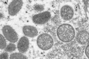 エムポックス(サル痘)で国内初の死者　海外渡航歴のない埼玉県の30代男性が死亡