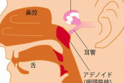 【急募】アデノイドの治し方