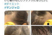 【悲報】ダイエット目的で『マンジャロ』を使用していた女性たち、ハゲまくる