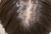 ワイの頭皮の分け目がキモいんやが（※画像あり）