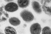 サル痘、世界で1000人が発症　密接接触せず感染報告も