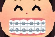 【画像あり】歯列矯正をやった結果がヤバすぎるｗｗｗｗｗｗ