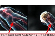 【画像】「脳血管カテーテル手術」とかいう怖すぎる手術法ｗｗｗｗｗｗ