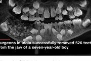 【閲覧注意】インドの少年の口から526本もの歯が見つかる