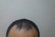 【画像】今30歳なんだけどこれ将来絶対ハゲる？