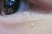 稗粒腫がある人、集合！