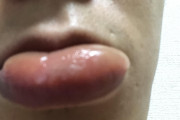 【助けて】ワイ、急に唇がめちゃくちゃ腫れてタラコが生成される…