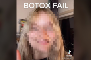 女性さん、自分のえくぼが気に入らずアゴにボトックス注射を打つ→ヤバイことになってしまう・・・