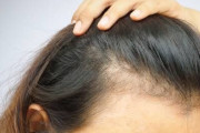 髪の悩み【薄毛】