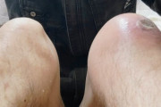 腫れ上がった俺の膝を見てくれ（※画像あり）