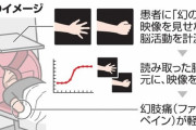【医療】失った腕が痛む「ファントムペイン」を軽減　脳の訓練で
