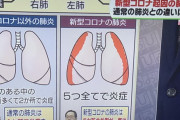 【医療】新型コロナ肺炎、一気に肺全体をメチャクチャにしてくるやべー奴だった