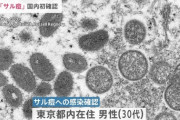 【悲報】サル痘感染者男性、7月中旬に帰国したものの25日まで受診せず
