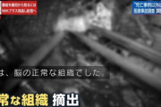 【脳外科医 竹田くん】NHKクローズアップ現代さん、正常な脳味噌を摘出する映像を放送してしまう