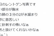 【悲報】金バエさん、肺が真っ白になってしまう