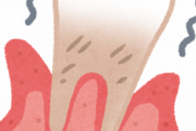 【相談】急性歯周病になって歯茎に膿が溜まり、歯医者で手術した。膿が出て痛みから解放された。しかし、その２日後
