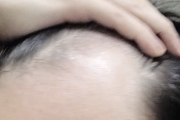 【悲報】ワイ（28）の頭皮、限界突破ww
