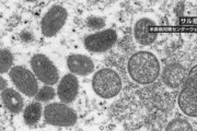 アメリカ､サル痘で｢公衆衛生の緊急事態｣を宣言　3日間で新規感染者が1300人以上