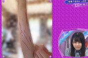 【欅坂46】これは完全に放送事故…増本綺良、猫にひっかかれた血だらけの写真がこちら・・・【欅って、書けない？】