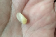ハイチュウ食ったら歯が取れた（※画像あり）
