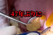 【動画】47年間歯を磨かなかった男ｗｗｗｗ