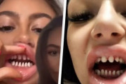 【画像】白く美しい歯を手に入れるため、一旦健康な歯を削り「サメの歯」にした結果ｗｗｗｗｗ