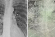 コロナ感染者の肺のレントゲン画像　喫煙者よりもヤバイと話題に