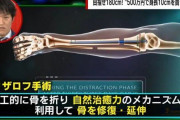 骨延長手術を受けたツイッタラー「脚の一部がガブリアスみたいになってしまった。ほんとに○ぬ可能性があって、これは○んでもおかしくないと思った」