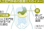 医療ミスで胃に人工肛門　病院経営の東海大を提訴