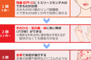 梅毒の感染者数が過去最多だって！？?