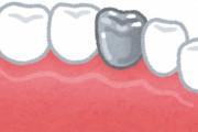 虫歯を銀歯で治しちゃう奴ｗｗｗｗｗｗｗｗｗｗ