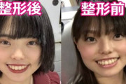 【画像】お笑いトリオ「ぼる塾はるか」さん、整形していたｗｗｗｗｗｗｗｗｗｗｗｗｗｗｗｗｗｗｗｗｗｗ