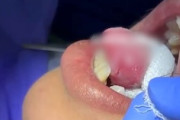 【動画】どういう事だよ？舌から歯を摘出する手術の様子が(@_@;)