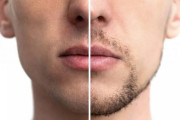 おまえら何で全身脱毛しないの？家に毛が落ちてない生活ってすげぇいいぞ。