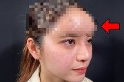 女性ユーチューバーさん、自分のおでこが気に入らず整形へ→ヤバイことになってしまう・・・