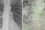 コロナ感染者の肺のレントゲン画像　喫煙者よりもヤバイと話題に