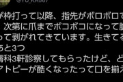 反ワク女子「助けて！夫がワクチン打ったら私の手がボロボロになったの?」