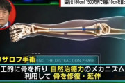 韓国人「身長を10cm伸ばした日本の医師をご覧ください」
