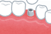 インプラント手術したけどしつもんある？