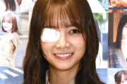 大丈夫か…！？ 北野日奈子ちゃんが眼帯してる…【乃木坂46】